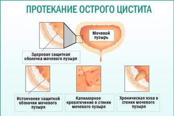 Какие бывают осложнения при женских инфекциях